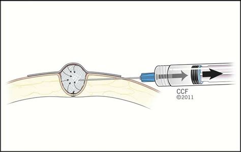 Vacuum dressing technique. 7 | Download Scientific Diagram