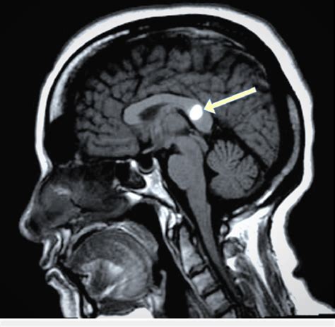 Brain magnetic resonance image (MRI T1W1) showing subacute hematoma of... | Download Scientific ...