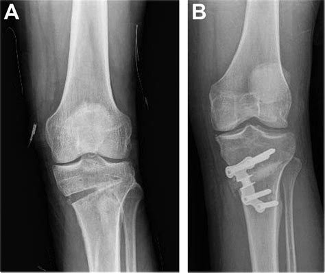 High Tibial Osteotomy Performed With All-PEEK Implants Demonstrates ...