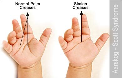 Aarskog–Scott Syndrome - Causes - Symptoms - Diagnosis - Treatment - FAQs