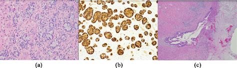 (a) Well-differentiated goblet cell carcinoma, present in submucosa.... | Download Scientific ...