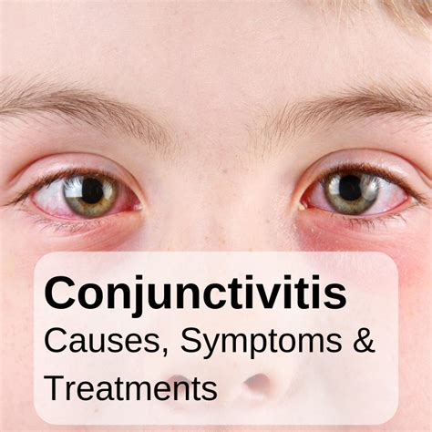 Midtown Optometry - Conjuctivitis (Pink Eye) —Diagnosis And Treatment