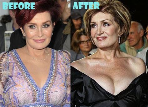 Sharon Osbourne Plastic Surgery Before and After Pictures - Lovely Surgery