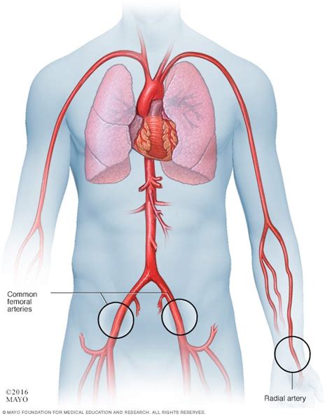 Coronary angiogram - Drugs.com