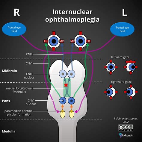 Internuclear Ophthalmoplegia - Neuropedia