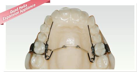 Quad Helix Expansion Appliance - Jeff Lipshatz Orthodontics