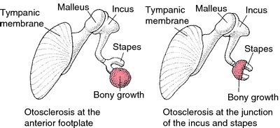 Otosclerosis | definition of otosclerosis by Medical dictionary