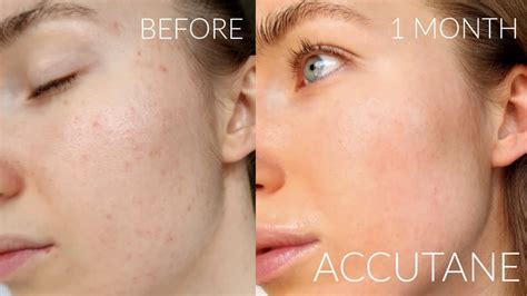 1 MONTH ACCUTANE JOURNEY PROGRESS FOR MILD ACNE | SIDE EFFECTS ...