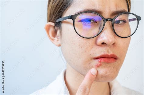 Asian woman pointing to Herpes labialis occur on her lower lip ...