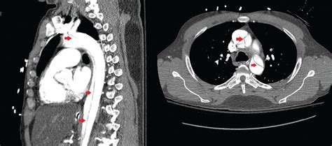 Aortic dissection presenting as ischemic limb | Cleveland Clinic ...