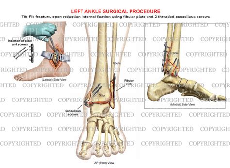 ORIF surgery of bimalleolar tib-fib fracture — Medical Art Works