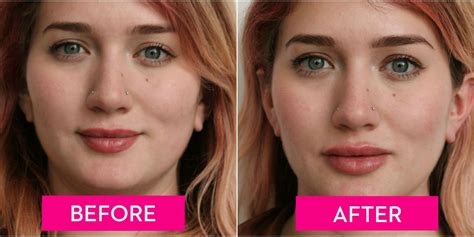 A Guide to Lip Injections, From the Cost to How They Feel - Before and After Lip Fillers