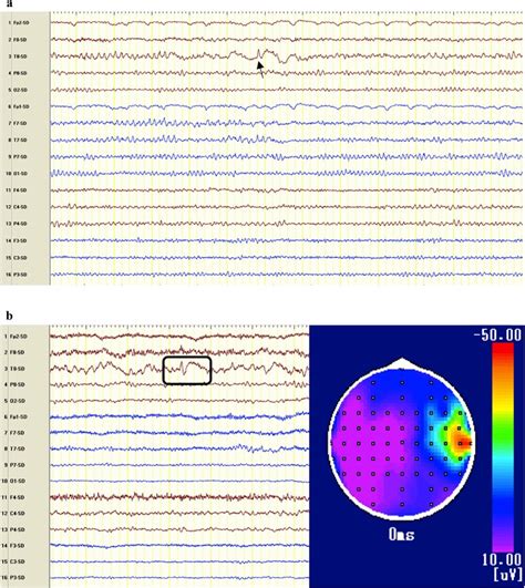 Epileptiform electroencephalogram (EEG) findings in stroke survivors. a... | Download Scientific ...