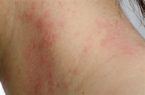 Contact Dermatitis, Skin Rash from Allergens triggered