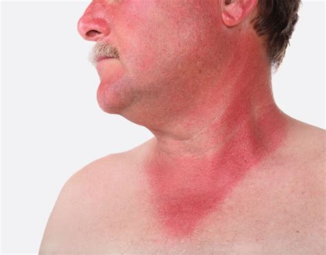 Sunburn | UV Rays, Sun Damage & Prevention | Britannica