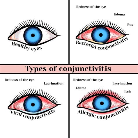 Conjunctivitis - New Jersey Eye Center