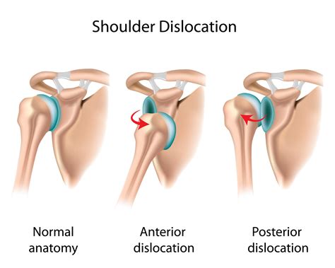 shoulder dislocation surgery recovery time