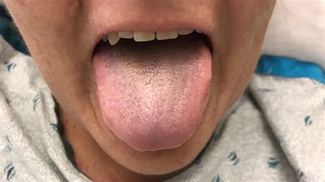 Black hairy tongue: What is it, and how do you get it