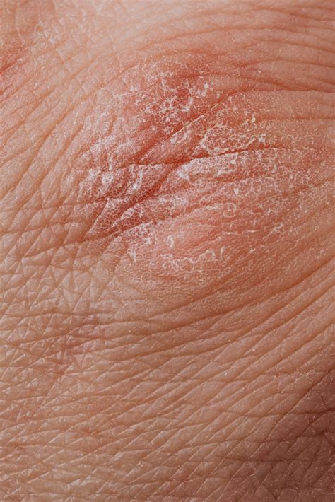 A Guide to Recognizing Morgellons Disease - WRCBtv.com | Chattanooga News, Weather & Sports