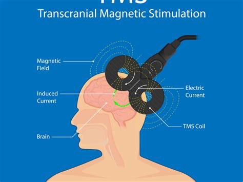 TMS Treatment Near Me, Tampa FL