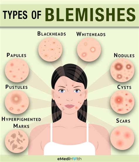 Understanding Acne Blemishes With a Skin Specialist