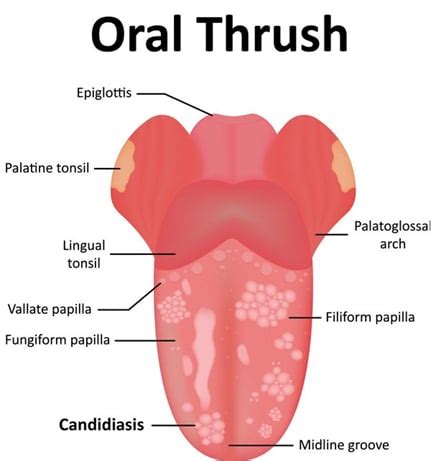 Oral Infection - Types, Causes, Treatment, Diagnosis & Prevention