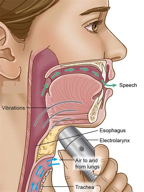 Total or partial laryngectomy procedure, complications, risks & recovery