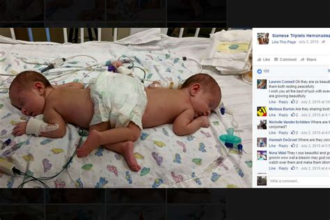 Formerly conjoined twins, triplet sister to celebrate 1st birthday at hospital in Texas ...