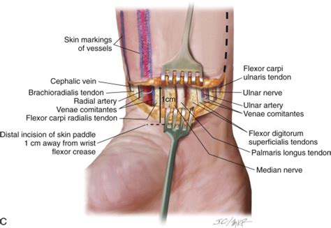 Radial Forearm Flap | Pocket Dentistry