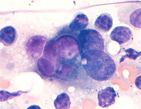 Transitional Cell Carcinoma