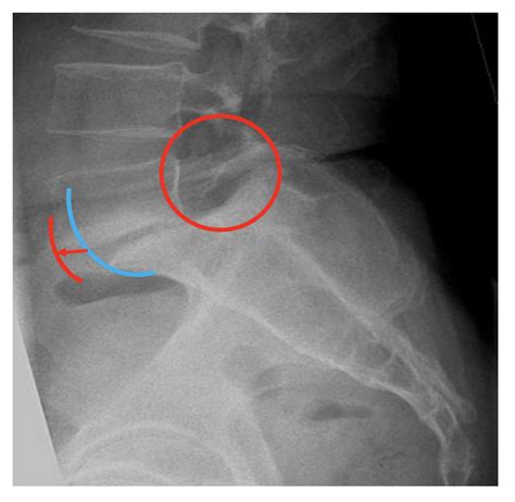 What is a pars defect? — London Neurosurgery Partnership