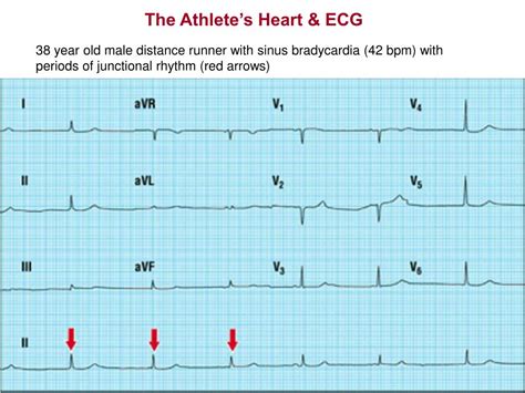 PPT - KINE 639 - Dr. Green Section 6 The Athlete’s Heart & ECG Reading ...