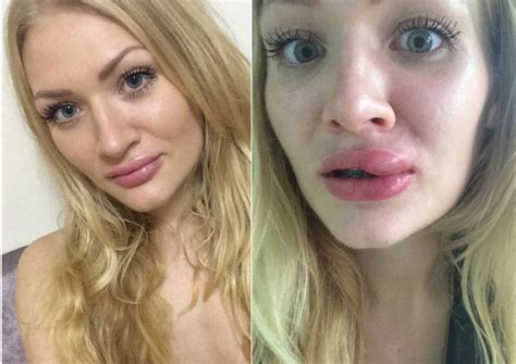 Cheap fillers gone wrong: Woman left with wart-like bumps on lips, Health News - AsiaOne