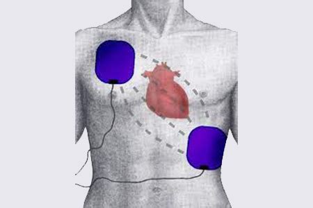 AED Pad Placement | Heartsmart