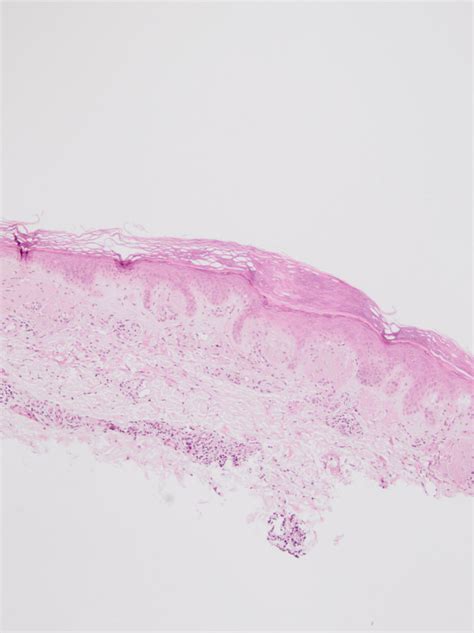 Macular Amyloidosis (Friction Amhyloidosis) - Dermatology Advisor