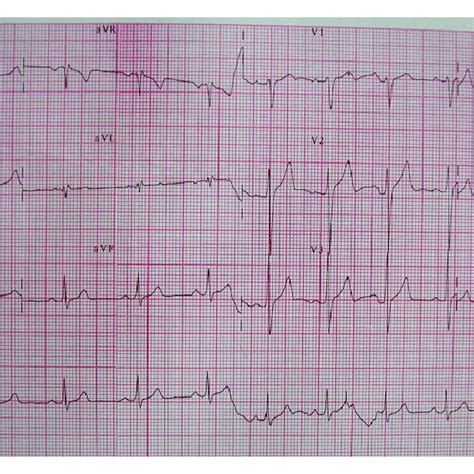 Normal electrocardiogram. | Download Scientific Diagram