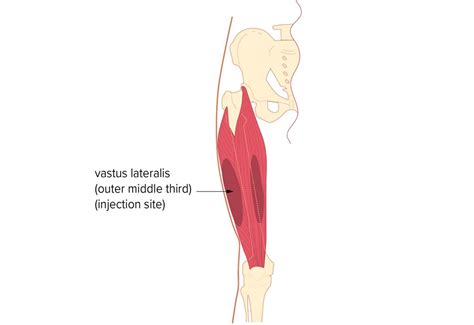 Intramuscular injection: Locations and administration