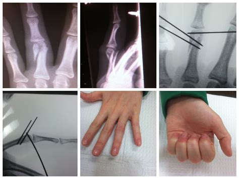Finger Fracture Treatment with Percutaneous Pins - John Erickson, MD