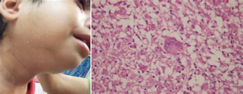 An Atypical Case of Parotid Gland Swelling and Arthritis in a Child