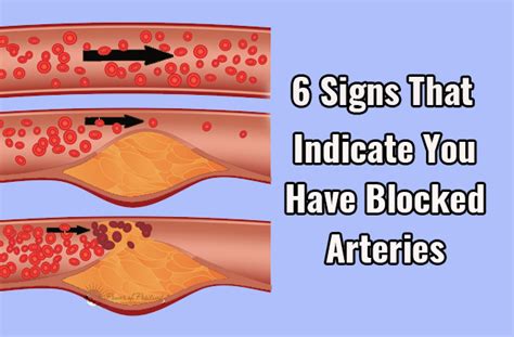 6 Signs That Indicate You Have Blocked Arteries - MindWaft