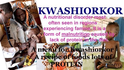 Marvelous Info About How To Prevent Kwashiorkor - Fewcontent