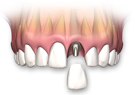 Single Tooth Dental Implants