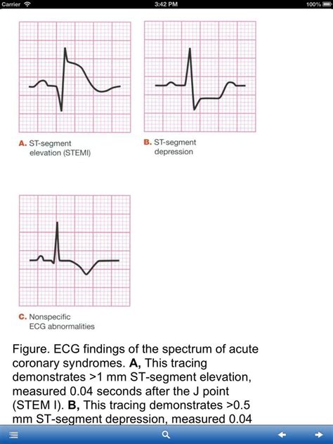 App Shopper: STEMI ST-Segment Elevation Myocardial Infarction (Medical)