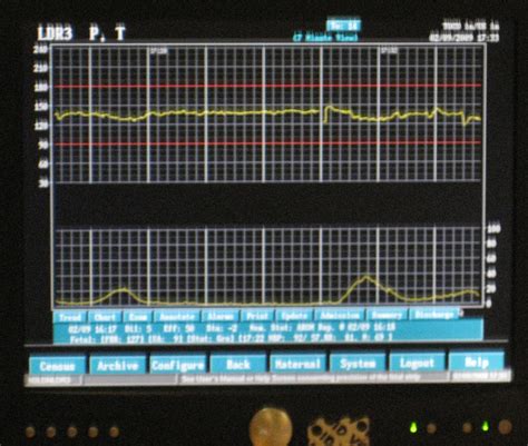 What you should know about fetal heart monitoring and fetal distress ...