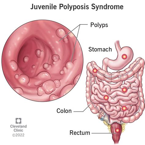 Juvenile Polyp