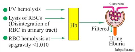 Urine Analysis: Part 9 – Hemoglobin in the urine (Hemoglobinuria ...