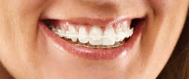 Which cosmetic braces are right for you? - The Online Dentist