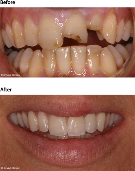 Before and After Dental Cases