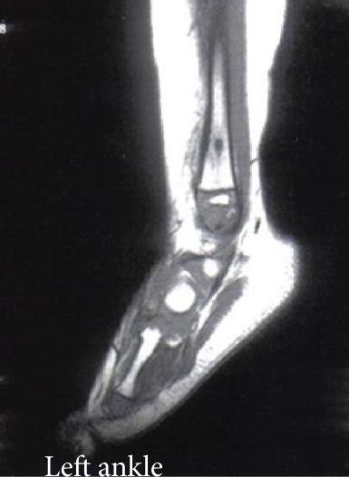 (a) X-ray with thickening of the distal part of the lateral malleolus ...