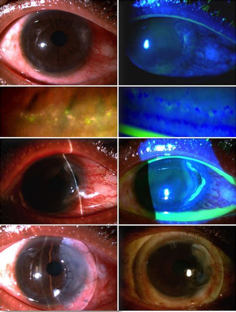 Management of severe and refractory Mooren's ulcers with rituximab | British Journal of ...